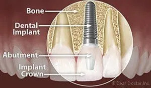 Dental implants | Dentist In Novi, MI | Arbor Dental Associates