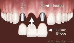 Dental implants | Dentist In Novi, MI | Arbor Dental Associates