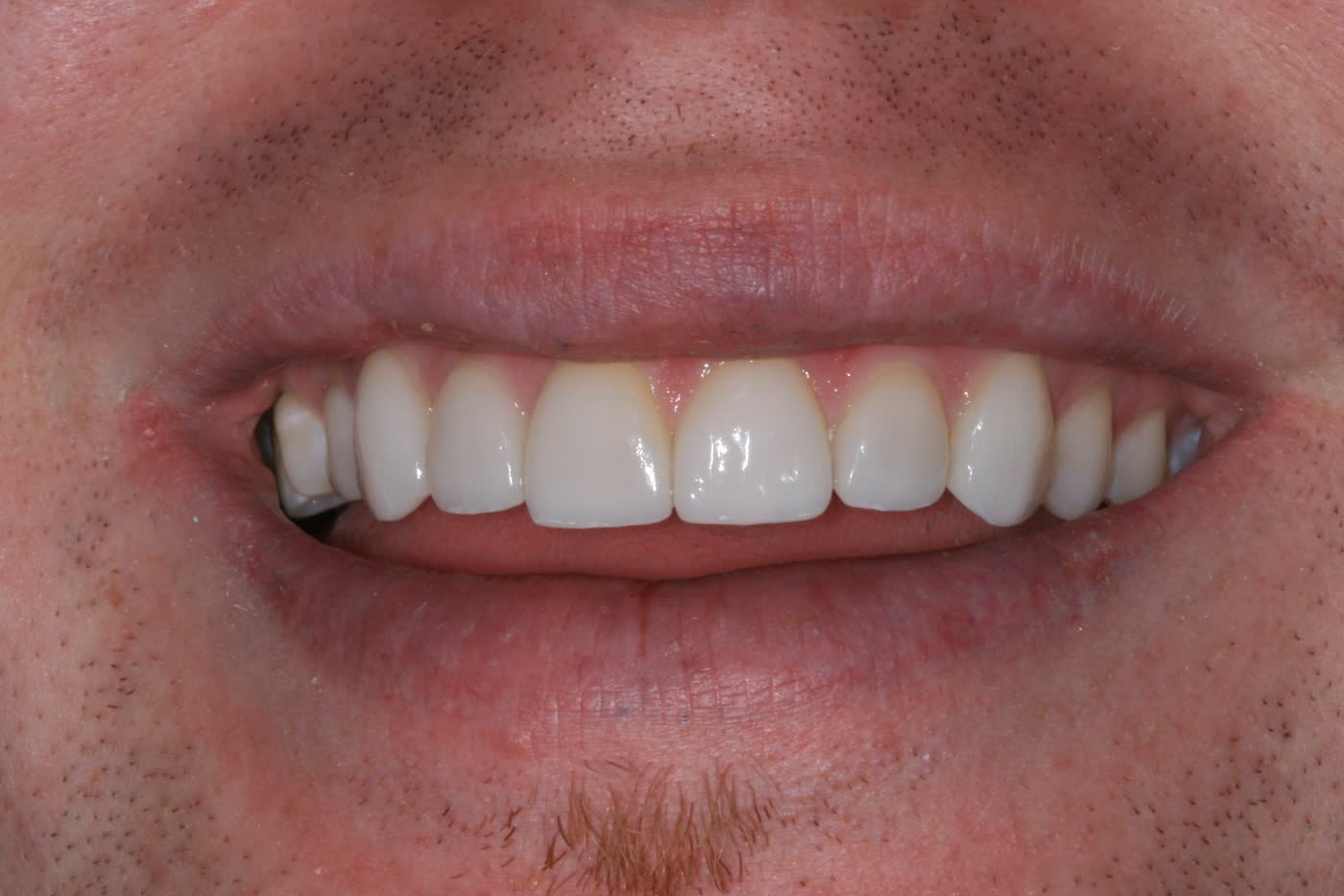 Before and after: porcelain veneers