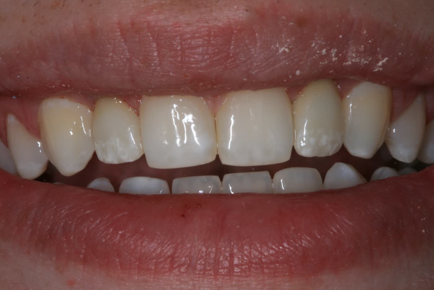 Before and after: missing teeth — replaced with implants.