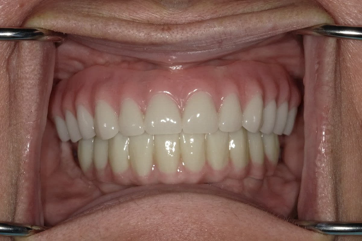 Before and after: upper denture, lower locator fixed&reg;