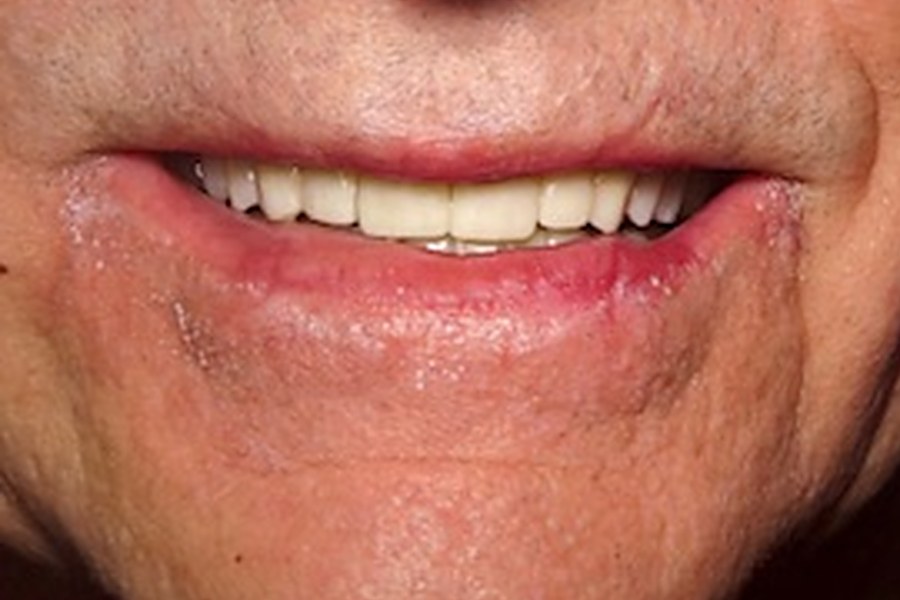 Before and after: full-mouth reconstruction