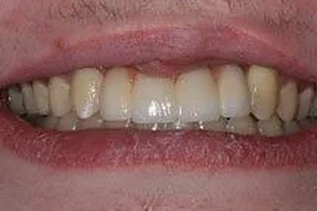 Before and after: implants after cleft palate repair — the front teeth replaced.