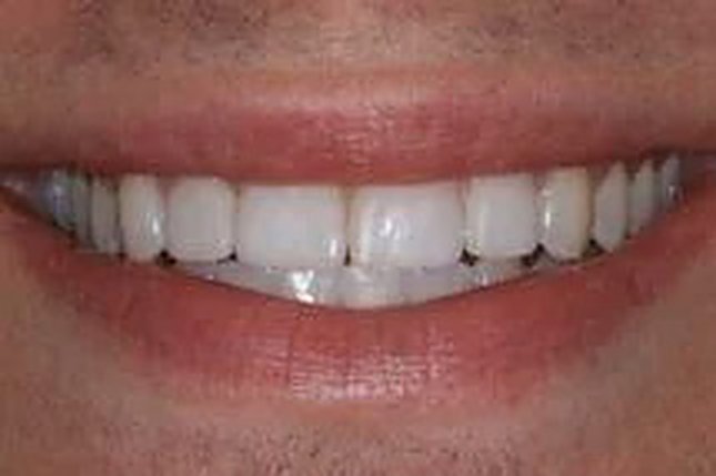 Before and after: a complete smile redesign.