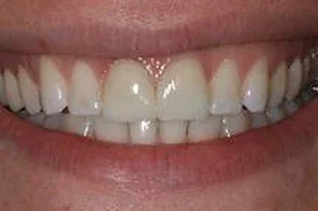 Before and after: discolored, uneven edges — unified.