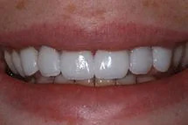 Before and after: veneers and lip repositioning