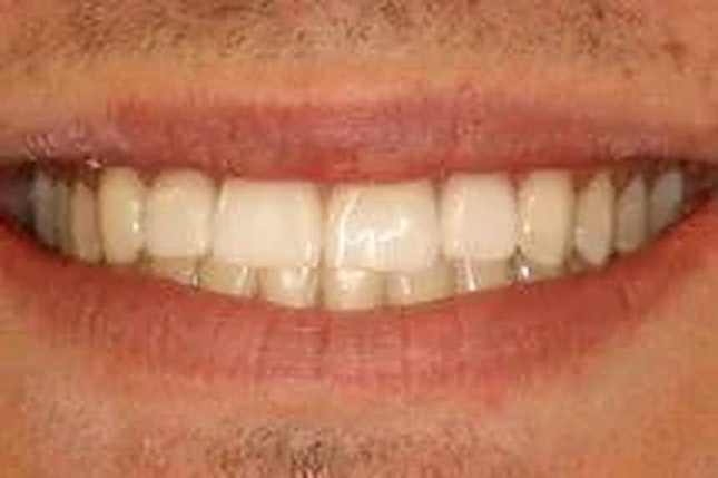 Before and after: clear aligner therapy