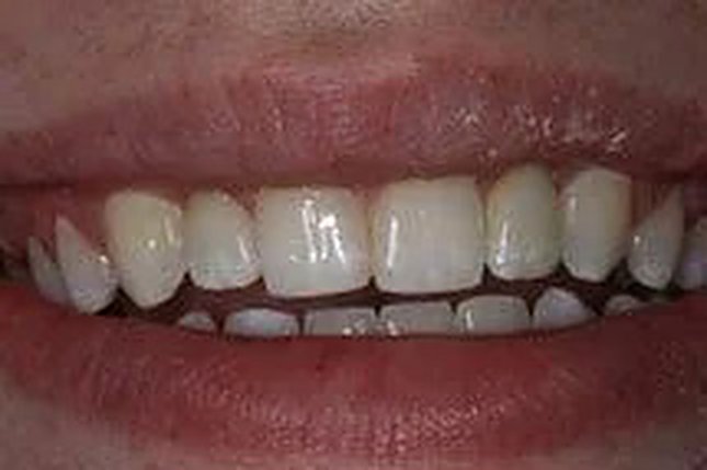 Before and after: implants and a veneer — the smile completed.