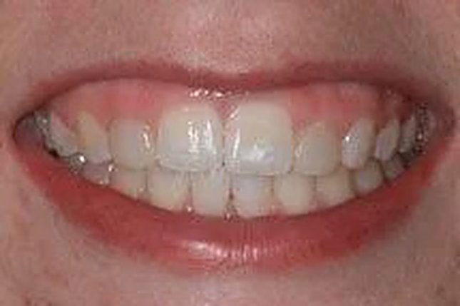 Before and after: k&ouml;r&reg; whitening and bonding