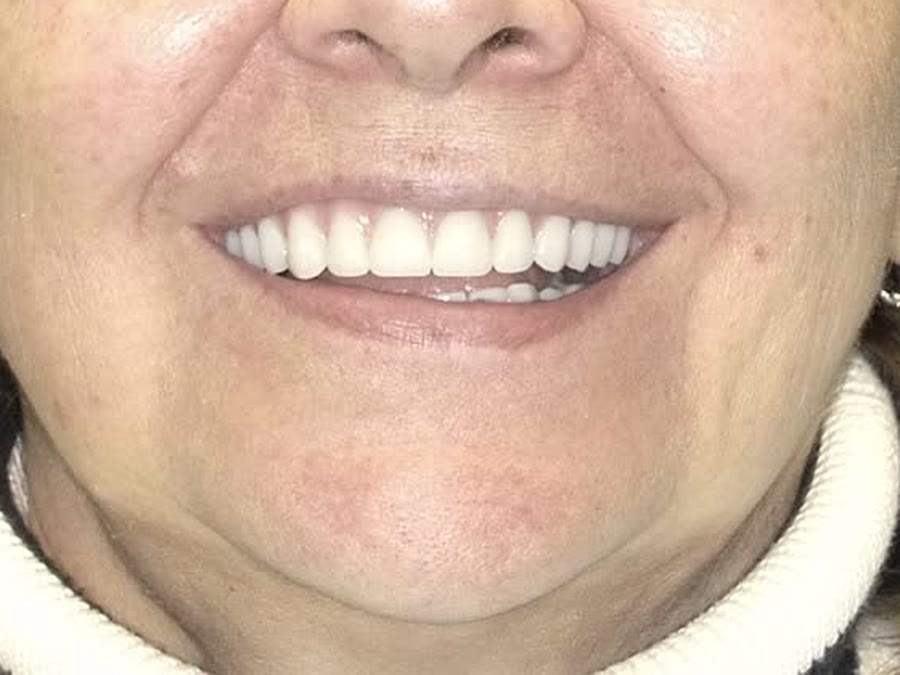 The new smile, the day it went home