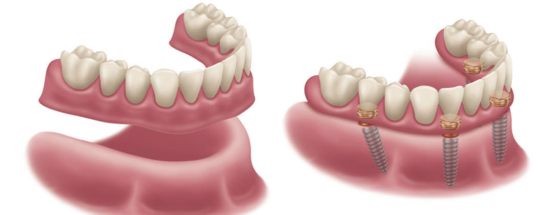 Manufacturer illustration comparing a conventional denture resting on the gums with a LOCATOR FIXED prosthesis secured on four implants
