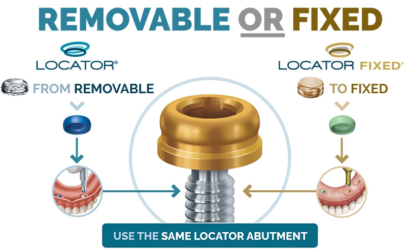 Zest Dental Solutions diagram: removable and fixed inserts both use the same LOCATOR abutment