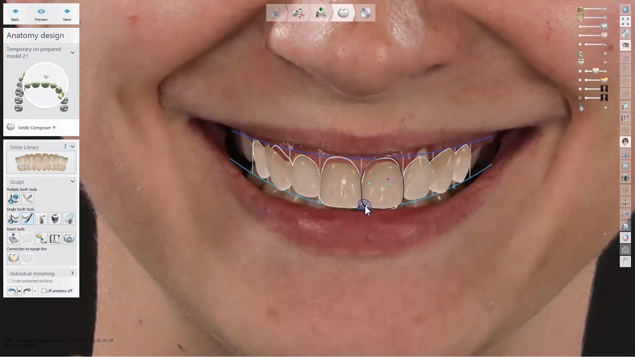 3Shape Smile Design software with a new smile being drawn onto a patient's photo